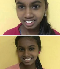 Orthodontic Correction